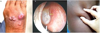 Clinical Spectrum, Molecular Characterization, Antifungal Susceptibility Testing of Exophiala spp. From India and Description of a Novel Exophiala Species, E. arunalokei sp. nov